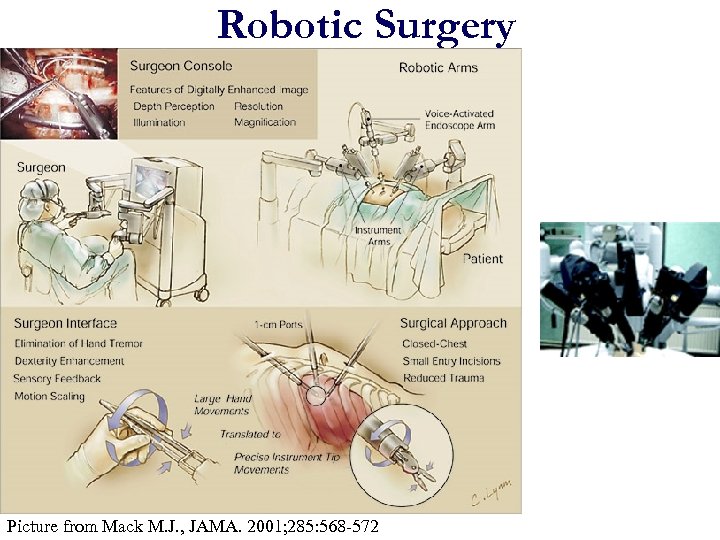 Robotic Surgery Picture from Mack M. J. , JAMA. 2001; 285: 568 -572 