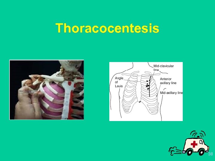 Thoracocentesis 38 