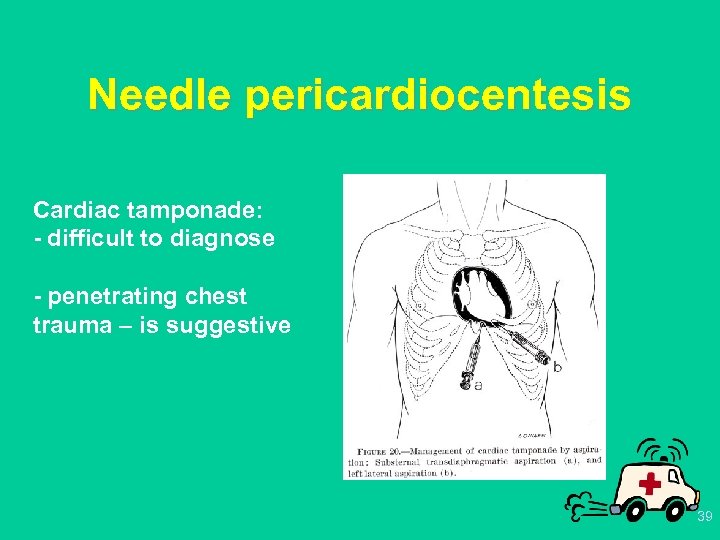 Needle pericardiocentesis Cardiac tamponade: - difficult to diagnose - penetrating chest trauma – is