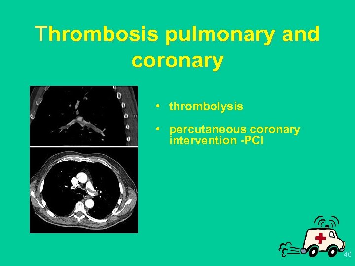 Thrombosis pulmonary and coronary • thrombolysis • percutaneous coronary intervention -PCI 40 