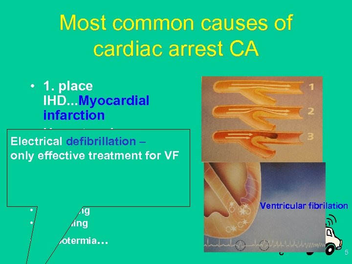 Most common causes of cardiac arrest CA • 1. place IHD. . . Myocardial