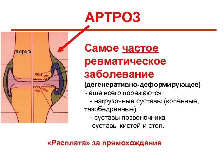 АРТРОЗ норма Самое частое ревматическое заболевание (дегенеративно-деформирующее) Чаще всего поражаются: - нагрузочные суставы (коленные,
