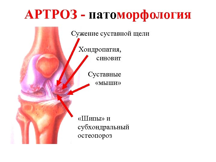 АРТРОЗ - патоморфология Сужение суставной щели Хондропатия, синовит Суставные «мыши» «Шипы» и субхондральный остеопороз