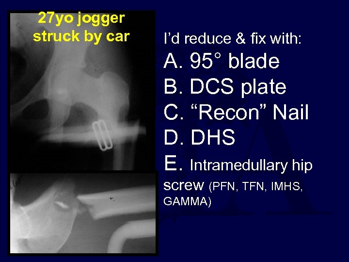 27 yo jogger struck by car I’d reduce & fix with: A. 95° blade