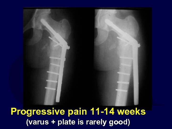 Progressive pain 11 -14 weeks (varus + plate is rarely good) 