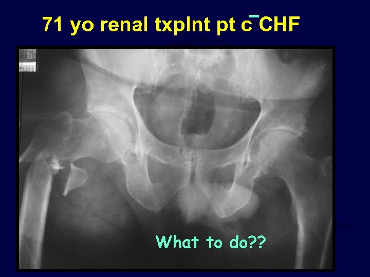 71 yo renal txplnt pt c CHF What to do? ? 