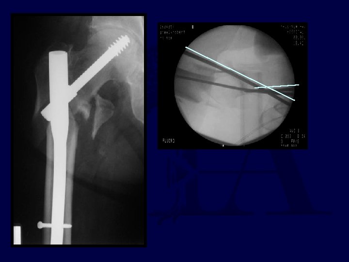 percutaneous reduction 