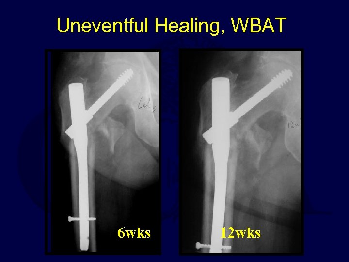 Uneventful Healing, WBAT 6 wks 12 wks 