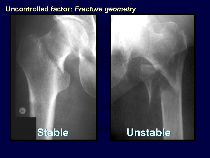 Uncontrolled factor: Fracture geometry Stable Unstable 