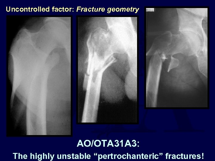 Uncontrolled factor: Fracture geometry AO/OTA 31 A 3: The highly unstable “pertrochanteric” fractures! 
