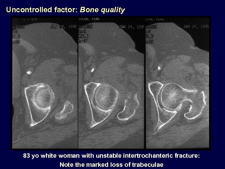 Uncontrolled factor: Bone quality 83 yo white woman with unstable intertrochanteric fracture: Note the