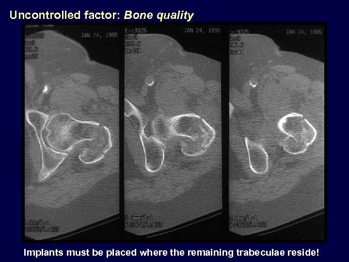 Uncontrolled factor: Bone quality Implants must be placed where the remaining trabeculae reside! 