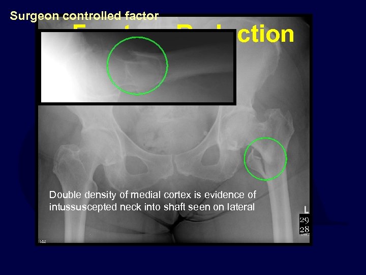 Surgeon controlled factor Fracture of Reduction Double density of medial cortex is evidence of