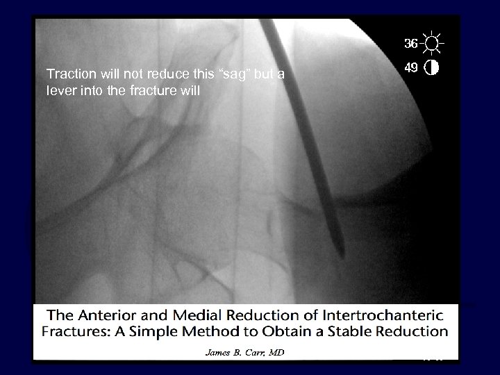 Traction will not reduce this “sag” but a lever into the fracture will 