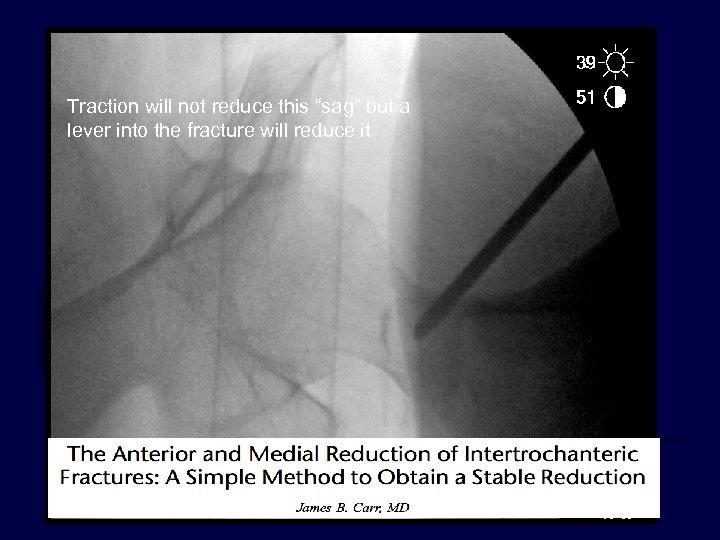 Traction will not reduce this “sag” but a lever into the fracture will reduce