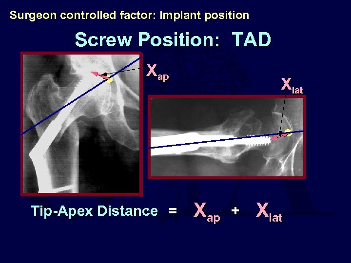 Surgeon controlled factor: Implant position Screw Position: TAD Xap Tip-Apex Distance = Xlat Xap