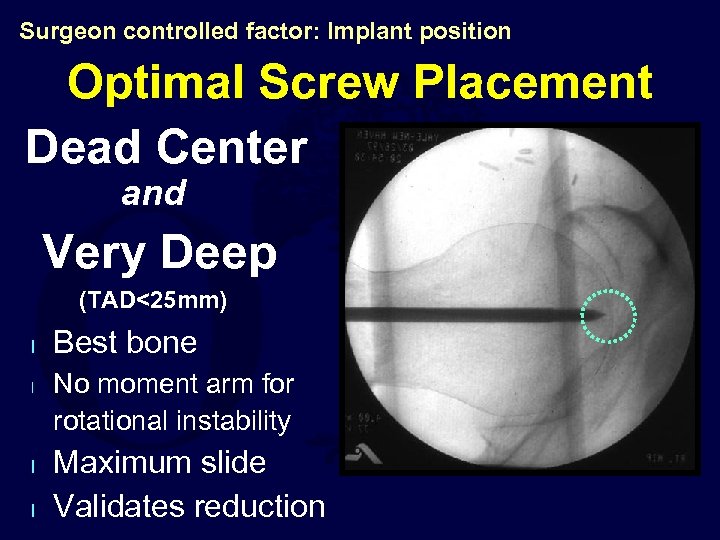 Surgeon controlled factor: Implant position Optimal Screw Placement Dead Center and Very Deep (TAD<25