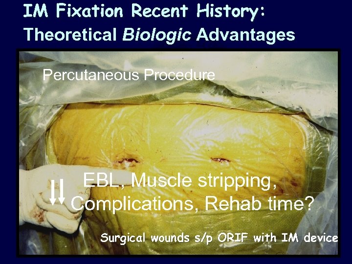 IM Fixation Recent History: Theoretical Biologic Advantages Percutaneous Procedure EBL, Muscle stripping, Complications, Rehab