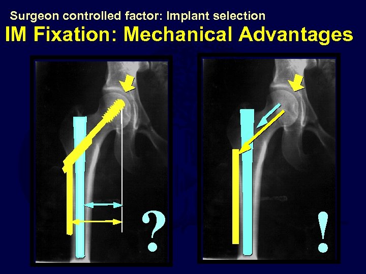 Surgeon controlled factor: Implant selection IM Fixation: Mechanical Advantages ? ! 