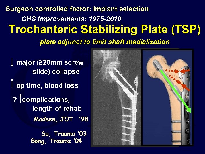 Surgeon controlled factor: Implant selection CHS Improvements: 1975 -2010 Trochanteric Stabilizing Plate (TSP) plate