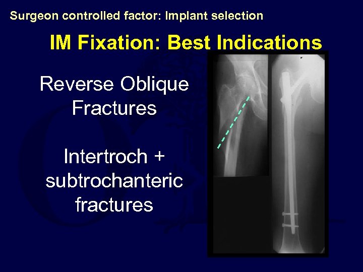 Surgeon controlled factor: Implant selection IM Fixation: Best Indications Reverse Oblique Fractures Intertroch +