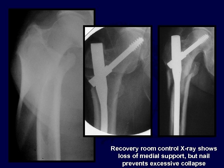 Recovery room control X-ray shows loss of medial support, but nail prevents excessive collapse