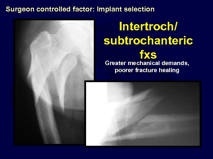 Surgeon controlled factor: Implant selection Intertroch/ subtrochanteric fxs Greater mechanical demands, poorer fracture healing