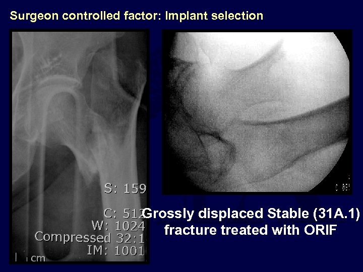 Surgeon controlled factor: Implant selection Grossly displaced Stable (31 A. 1) fracture treated with