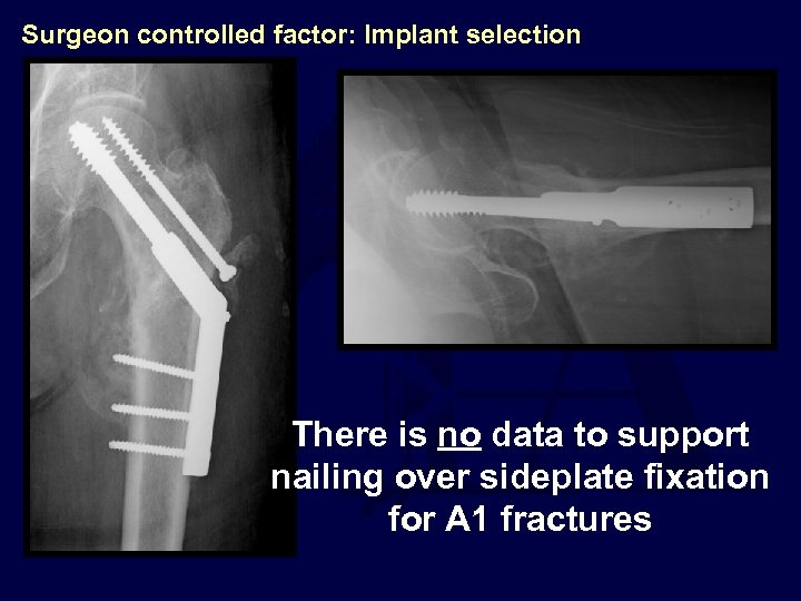 Surgeon controlled factor: Implant selection There is no data to support nailing over sideplate