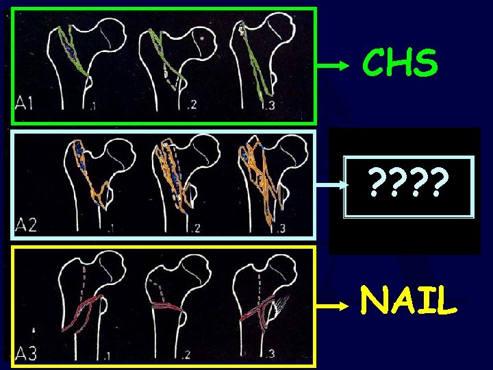 CHS ? ? 31 AO / OTA NAIL 