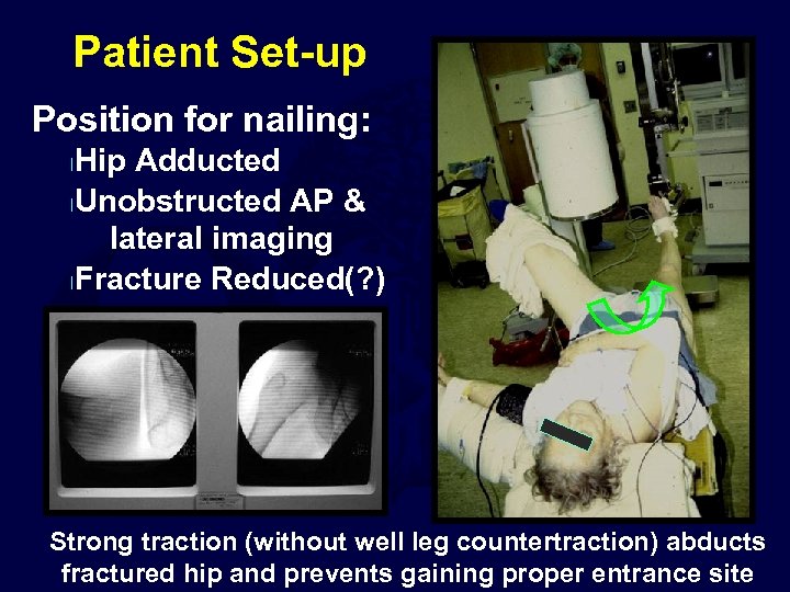 Patient Set-up Position for nailing: Hip Adducted l. Unobstructed AP & lateral imaging l.