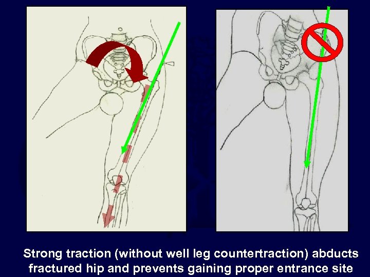 Strong traction (without well leg countertraction) abducts fractured hip and prevents gaining proper entrance