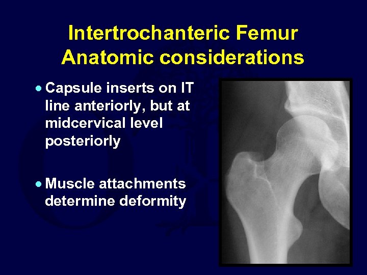 Intertrochanteric Femur Anatomic considerations · Capsule inserts on IT line anteriorly, but at midcervical