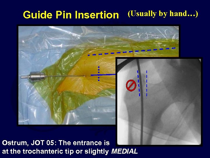 Guide Pin Insertion (Usually by hand…) Ostrum, JOT 05: The entrance is at the