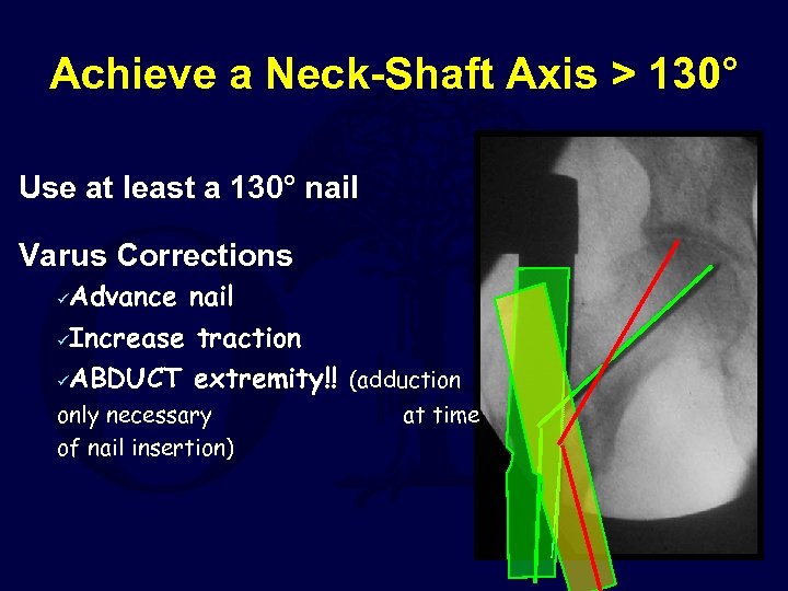 Achieve a Neck-Shaft Axis > 130° Use at least a 130° nail Varus Corrections