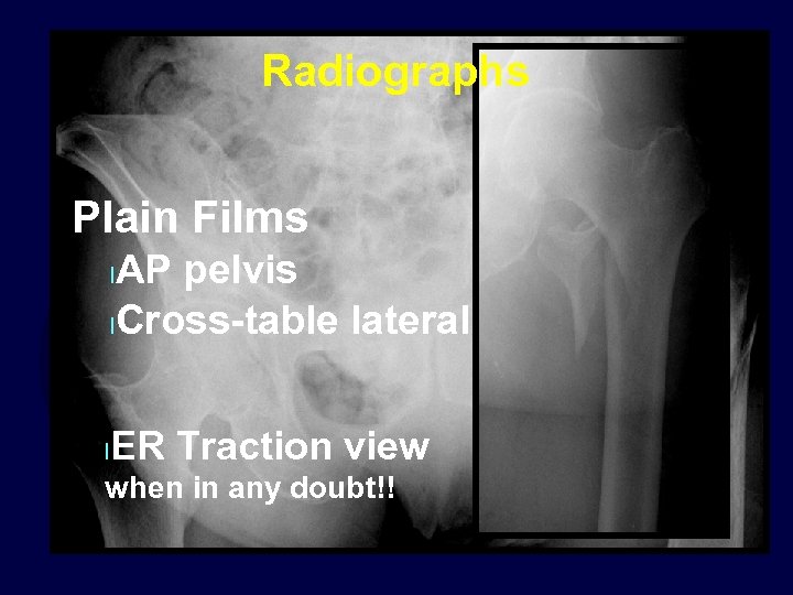 Radiographs Plain Films AP pelvis l. Cross-table lateral l l ER Traction view when