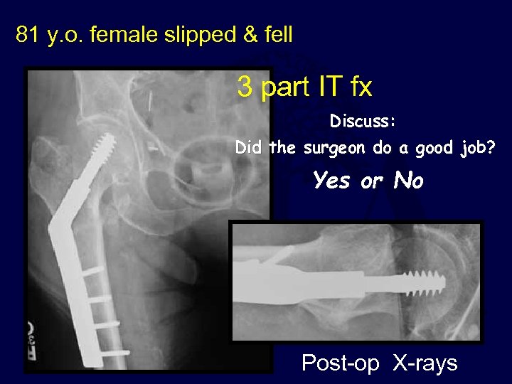 81 y. o. female slipped & fell 3 part IT fx Discuss: Did the