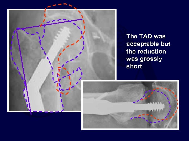 The TAD was acceptable but the reduction was grossly short 