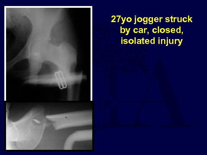 27 yo jogger struck by car, closed, isolated injury 