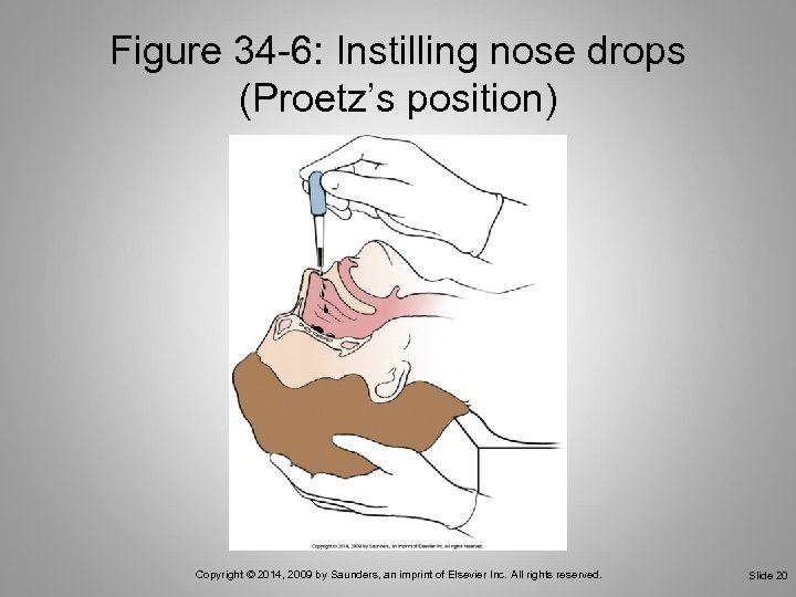 Figure 34 -6: Instilling nose drops (Proetz’s position) Copyright © 2014, 2009 by Saunders,