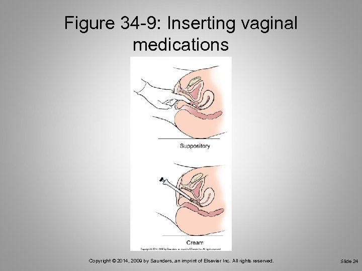 Figure 34 -9: Inserting vaginal medications Copyright © 2014, 2009 by Saunders, an imprint