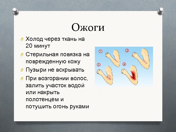Ожоги O Холод через ткань на 20 минут O Стерильная повязка на поврежденную кожу