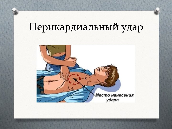 Перикардиальный удар 