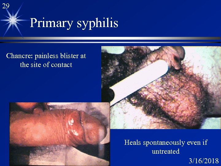 29 Primary syphilis Chancre: painless blister at the site of contact Heals spontaneously even