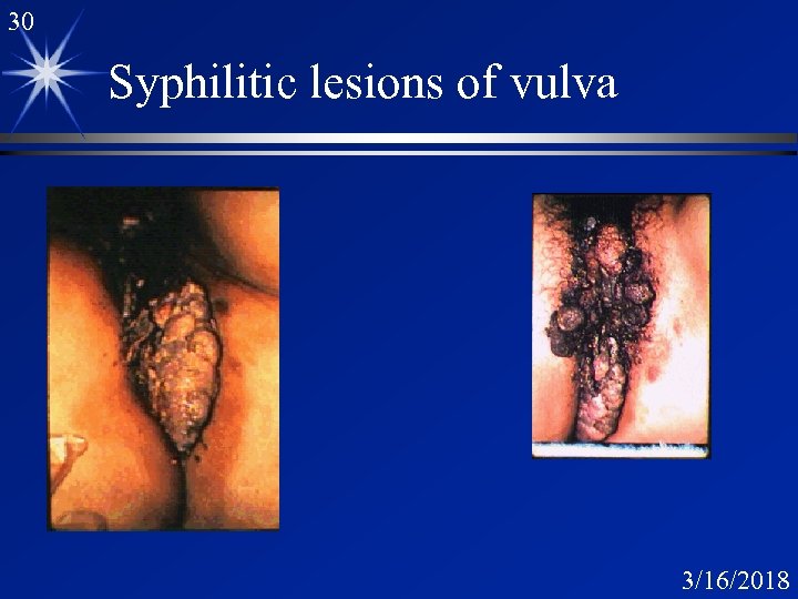 30 Syphilitic lesions of vulva 3/16/2018 