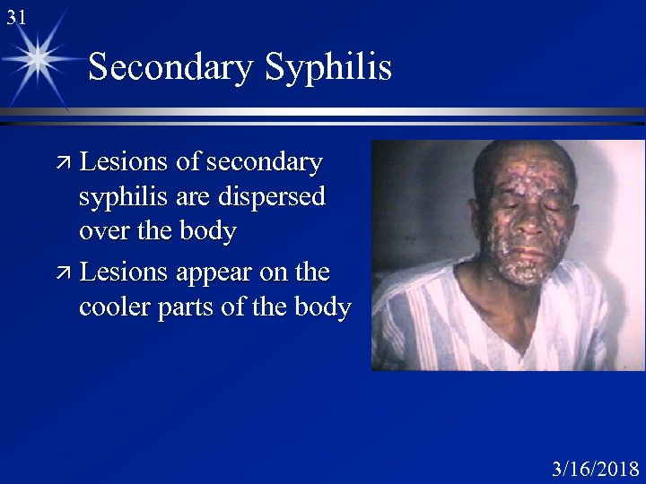 31 Secondary Syphilis ä Lesions of secondary syphilis are dispersed over the body ä