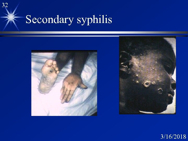32 Secondary syphilis 3/16/2018 