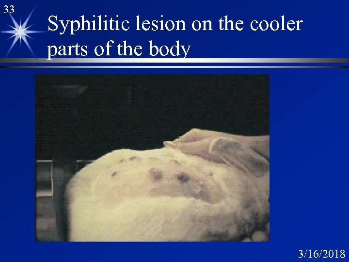 33 Syphilitic lesion on the cooler parts of the body 3/16/2018 