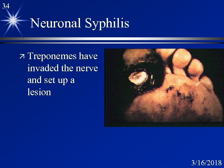 34 Neuronal Syphilis ä Treponemes have invaded the nerve and set up a lesion