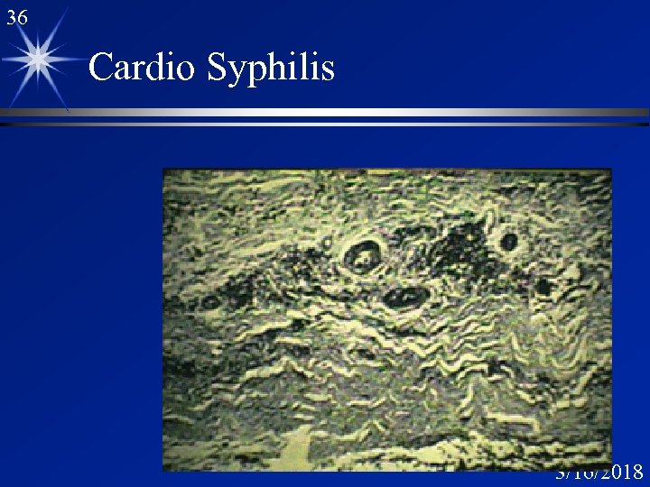 36 Cardio Syphilis 3/16/2018 